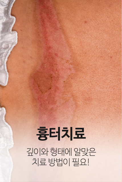 흉터치료